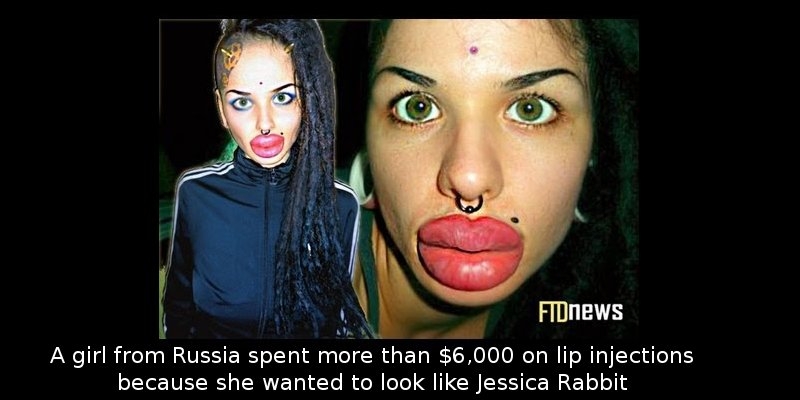 Did You Know That a Russian Girl Spent More Than $6k On Lip Injections Because She Wanted To…