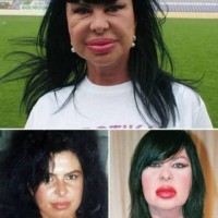 Plastic Surgery Went Horribly Wrong